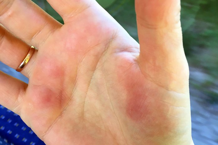 Close-up of a hand with reddened areas on the palm. In the background you can see train seats and a blurred landscape.